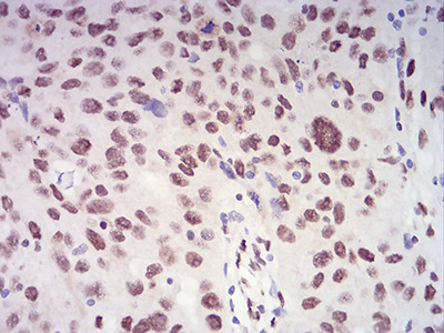 Fig5: Immunohistochemical analysis of paraffin-embedded human ovarian cancer tissue using anti- XRN2 antibody. Counter stained with hematoxylin.