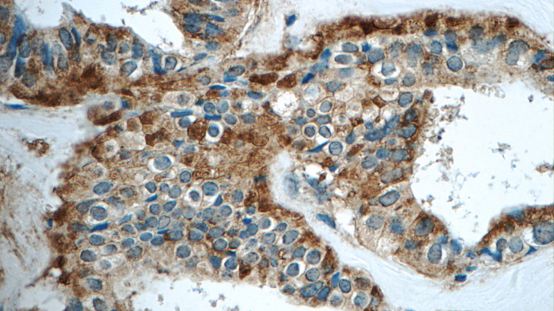 Immunohistochemistry of paraffin-embedded human breast cancer tissue slide using Catalog No:111009(GNPDA2 Antibody) at dilution of 1:50 (under 40x lens)