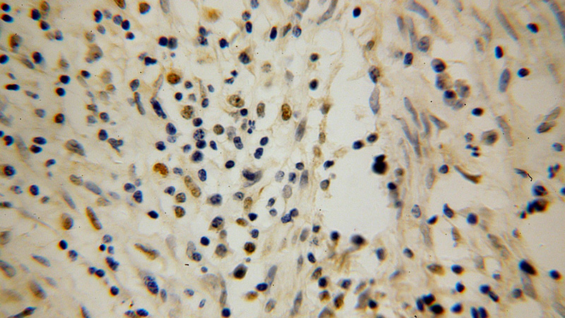 Immunohistochemical of paraffin-embedded human cervical cancer using Catalog No:114004(POLK antibody) at dilution of 1:100 (under 40x lens)