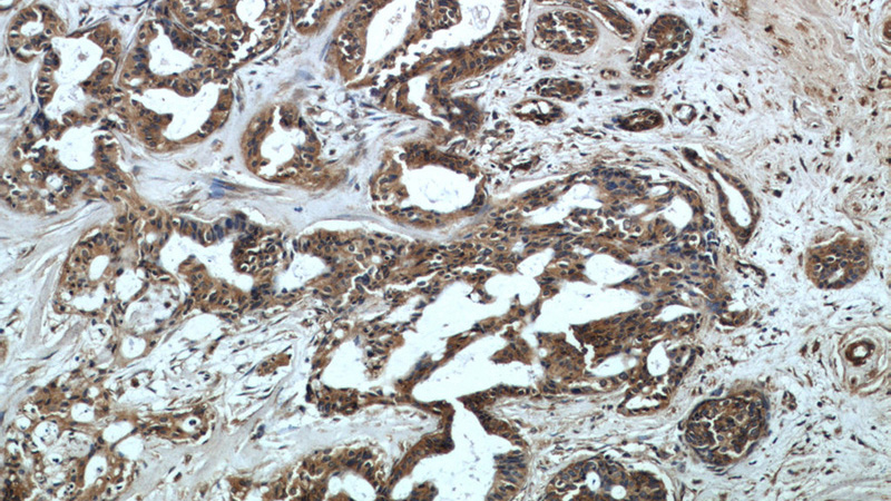 Immunohistochemical of paraffin-embedded human breast cancer using Catalog No:112359(LTBP1 antibody) at dilution of 1:50 (under 10x lens)