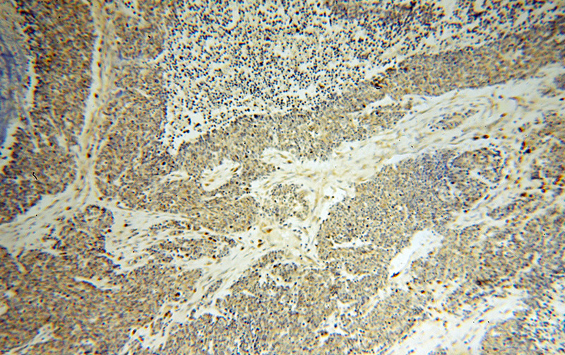 Immunohistochemical of paraffin-embedded human lung cancer using Catalog No:109900(DEXI antibody) at dilution of 1:100 (under 10x lens)