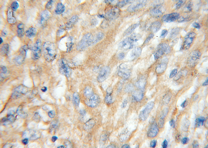 Immunohistochemical of paraffin-embedded human gliomas using Catalog No:115594(SRP68 antibody) at dilution of 1:100 (under 10x lens)