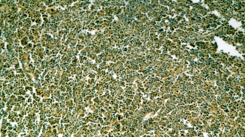 Immunohistochemical of paraffin-embedded human lymphoma using Catalog No:109972(DNTT,TDT antibody) at dilution of 1:50 (under 10x lens)