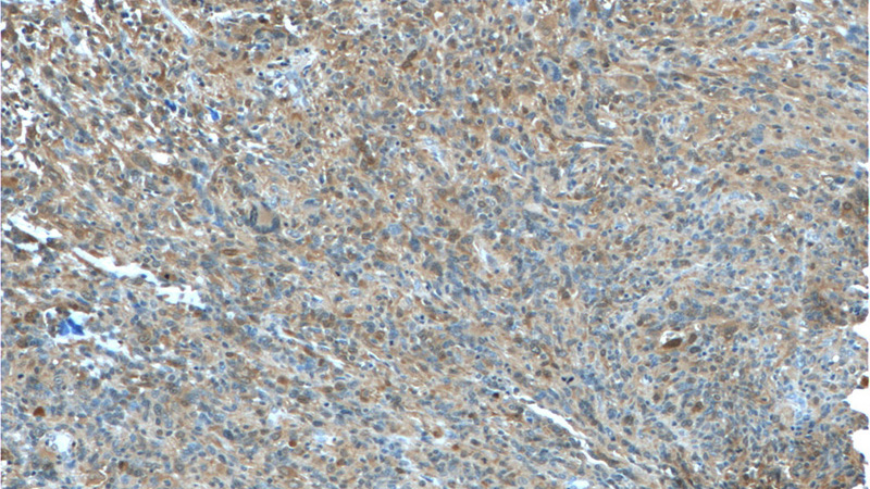 Immunohistochemistry of paraffin-embedded human gliomas tissue slide using Catalog No:111602(IDH1 Antibody) at dilution of 1:50 (under 10x lens)