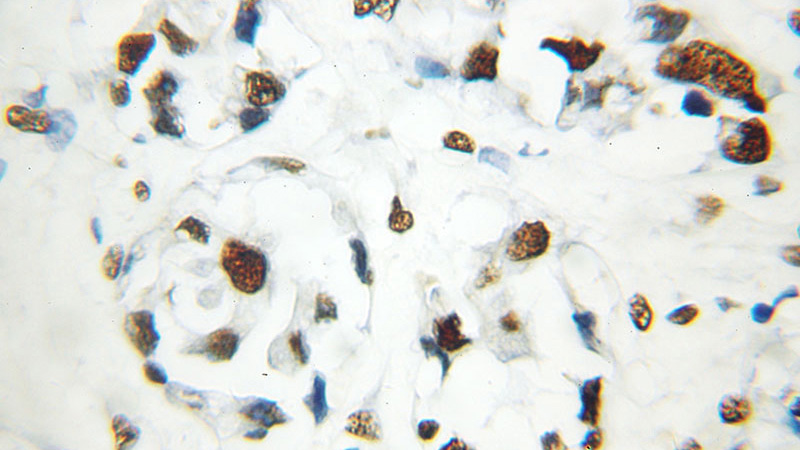 Immunohistochemical of paraffin-embedded human breast cancer using Catalog No:115044(SAFB2 antibody) at dilution of 1:50 (under 40x lens)