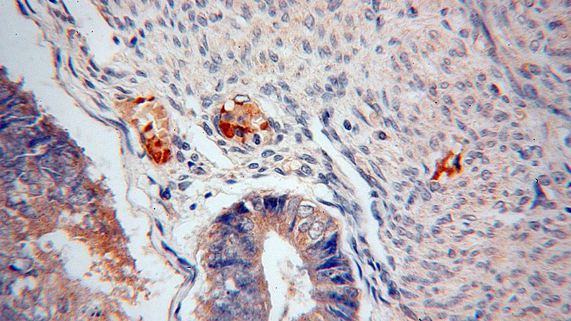 Immunohistochemical of paraffin-embedded human endometrial cancer using Catalog No:114838(RPS27 antibody) at dilution of 1:50 (under 40x lens)
