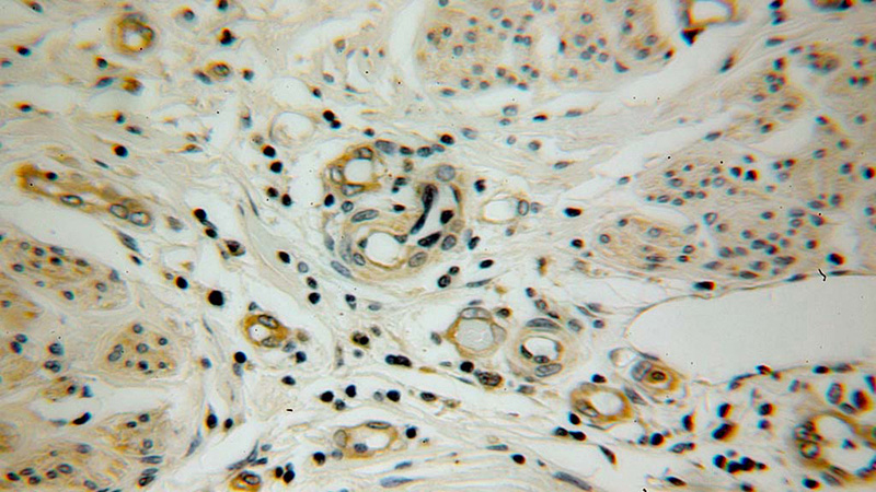 Immunohistochemical of paraffin-embedded human cervical cancer using Catalog No:114123(PPID antibody) at dilution of 1:50 (under 40x lens)
