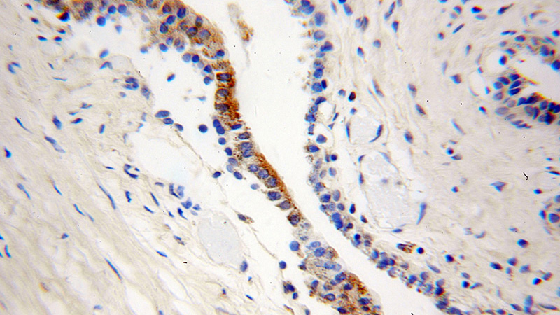 Immunohistochemical of paraffin-embedded human gliomas using Catalog No:108199(ARL2BP antibody) at dilution of 1:50 (under 40x lens)
