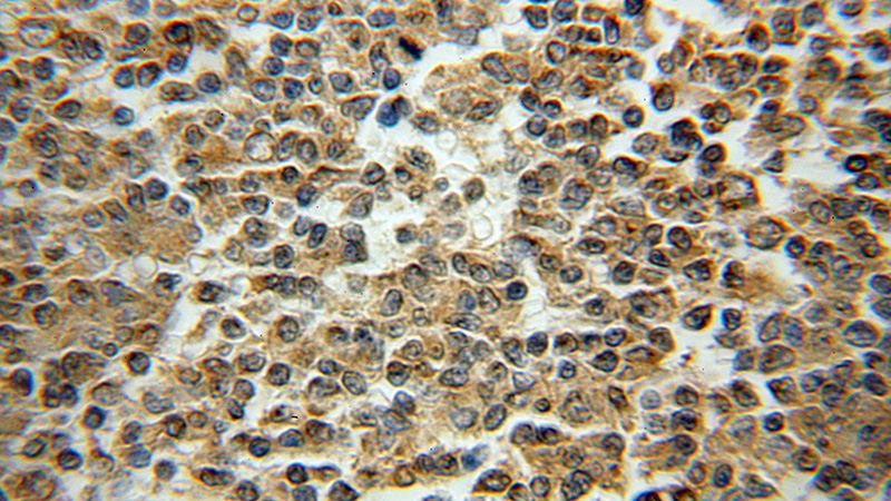 Immunohistochemical of paraffin-embedded human lymphoma using Catalog No:110131(dynactin-2 antibody) at dilution of 1:50 (under 10x lens)