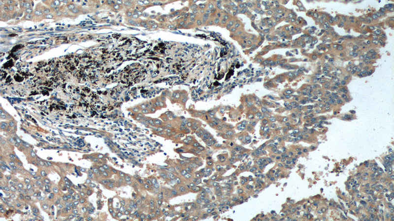 Immunohistochemistry of paraffin-embedded human lung cancer tissue slide using Catalog No:114923(RRM1 Antibody) at dilution of 1:200 (under 10x lens).