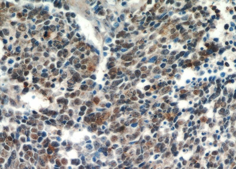 Immunohistochemical of paraffin-embedded human lung cancer using Catalog No:116389(NKX2-1 antibody) at dilution of 1:50 (under 40x lens)