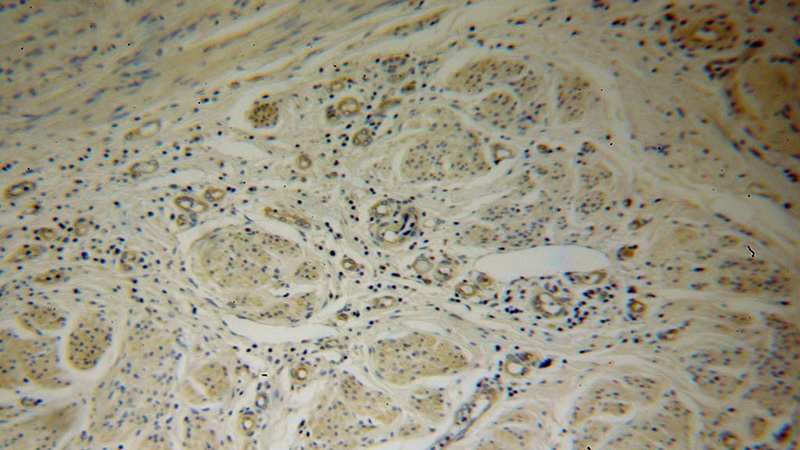 Immunohistochemical of paraffin-embedded human cervical cancer using Catalog No:114123(PPID antibody) at dilution of 1:50 (under 10x lens)