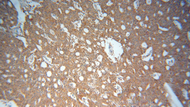 Immunohistochemical of paraffin-embedded human prostate cancer using Catalog No:110242(EML2 antibody) at dilution of 1:100 (under 10x lens)
