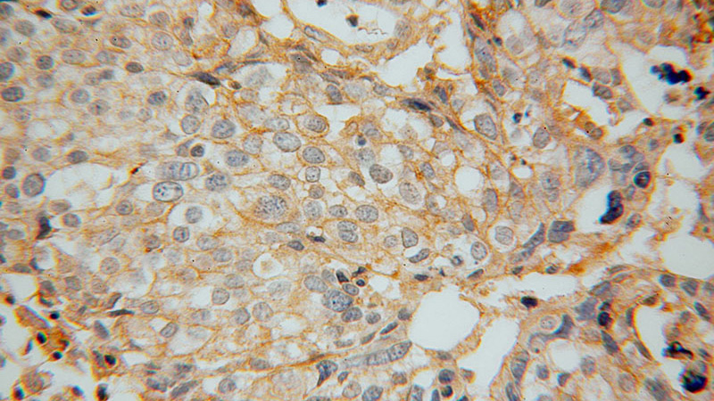 Immunohistochemical of paraffin-embedded human ovary tumor using Catalog No:110995(GNB2 antibody) at dilution of 1:50 (under 40x lens)