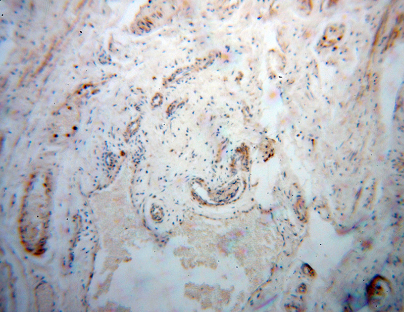 Immunohistochemical of paraffin-embedded human colon cancer using Catalog No:109884(DEFB1 antibody) at dilution of 1:100 (under 10x lens)