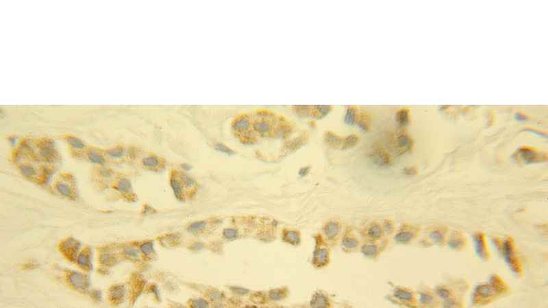 Immunohistochemical of paraffin-embedded human breast cancer using Catalog No:109744(CUL4A antibody) at dilution of 1:100 (under 10x lens)