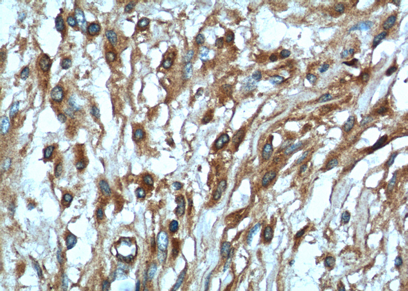 Immunohistochemistry of paraffin-embedded human meningioma tissue slide using Catalog No:113136(NF2 Antibody) at dilution of 1:50 (under 40x lens)
