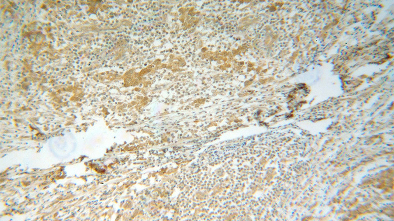 Immunohistochemical of paraffin-embedded human breast cancer using Catalog No:110979(GIPC1 antibody) at dilution of 1:100 (under 10x lens)