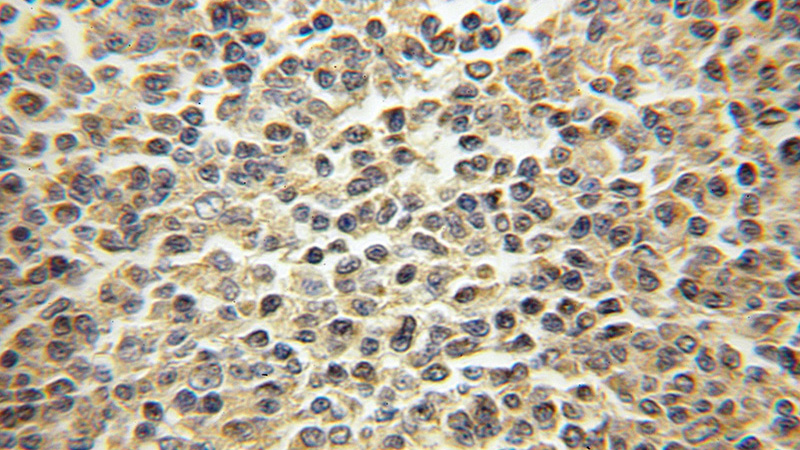 Immunohistochemical of paraffin-embedded human lymphoma using Catalog No:113106(NEK9 antibody) at dilution of 1:50 (under 10x lens)