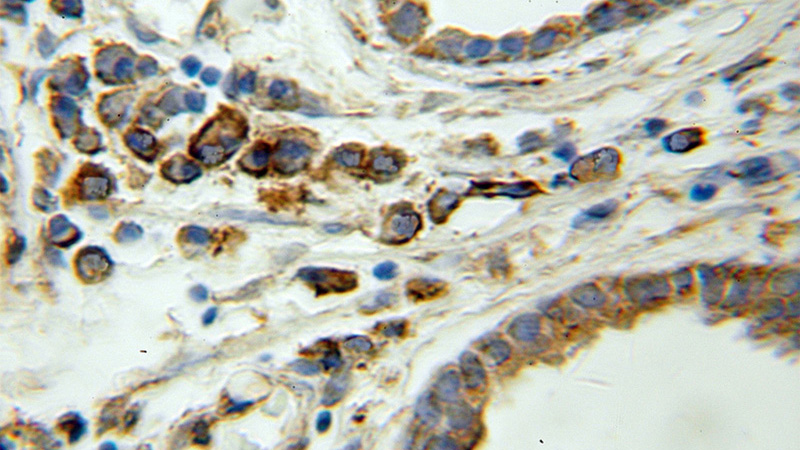 Immunohistochemical of paraffin-embedded human prostate cancer using Catalog No:113681(PDIA1 antibody) at dilution of 1:50 (under 40x lens)