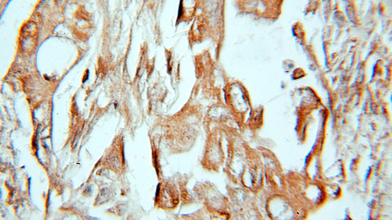 Immunohistochemical of paraffin-embedded human lung cancer using Catalog No:110148(DAG1 antibody) at dilution of 1:10 (under 10x lens)