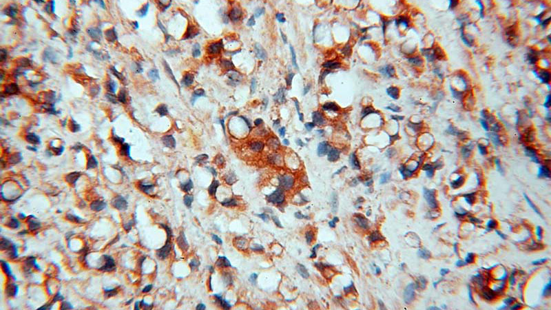 Immunohistochemical of paraffin-embedded human prostate cancer using Catalog No:111547(HSD17B4 antibody) at dilution of 1:100 (under 40x lens)