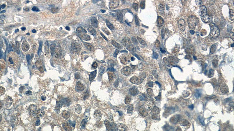 Immunohistochemistry of paraffin-embedded human breast cancer tissue slide using Catalog No:107590(SMARCE1 Antibody) at dilution of 1:100 (under 40x lens)