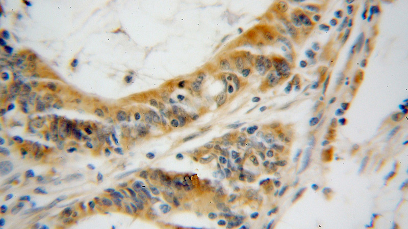 Immunohistochemical of paraffin-embedded human colon cancer using Catalog No:116714(VAPA antibody) at dilution of 1:100 (under 40x lens)