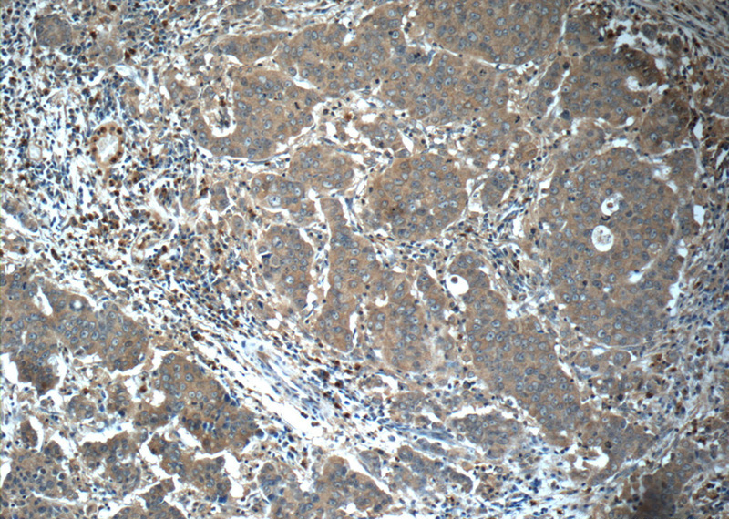 Immunohistochemistry of paraffin-embedded human prostate cancer tissue slide using Catalog No:114523(RAF1 Antibody) at dilution of 1:50 (under 10x lens)