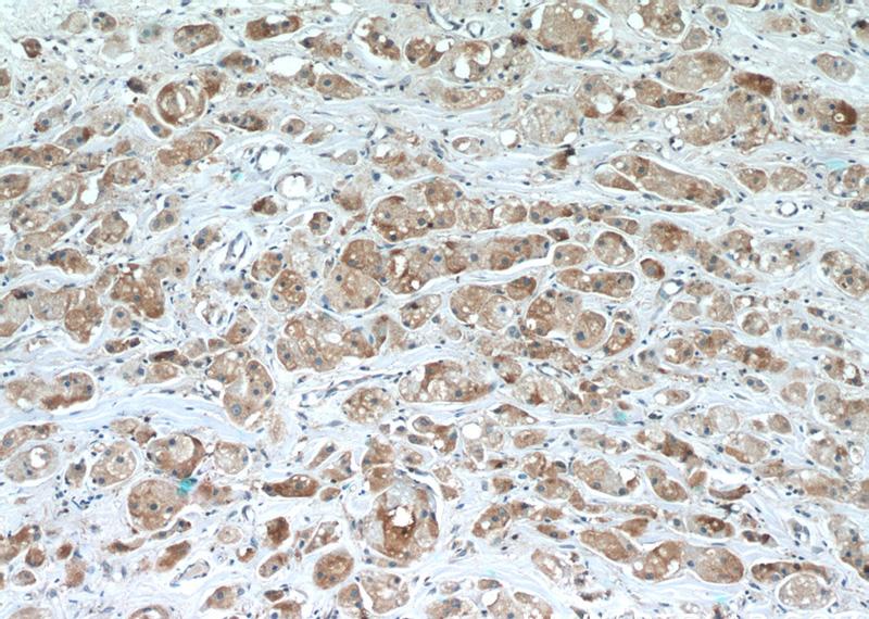 Immunohistochemistry of paraffin-embedded human breast cancer slide using Catalog No:116193(TMEM59 Antibody) at dilution of 1:50 (under 10x lens)