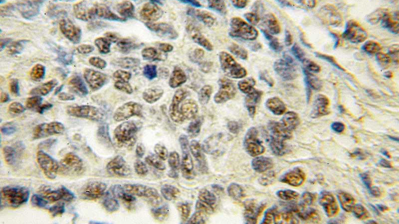 Immunohistochemical of paraffin-embedded human ovary tumor using Catalog No:115899(TCEAL7 antibody) at dilution of 1:50 (under 40x lens)