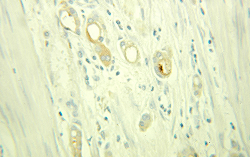 Immunohistochemical of paraffin-embedded human colon cancer using Catalog No:108030(APOD antibody) at dilution of 1:100 (under 25x lens)