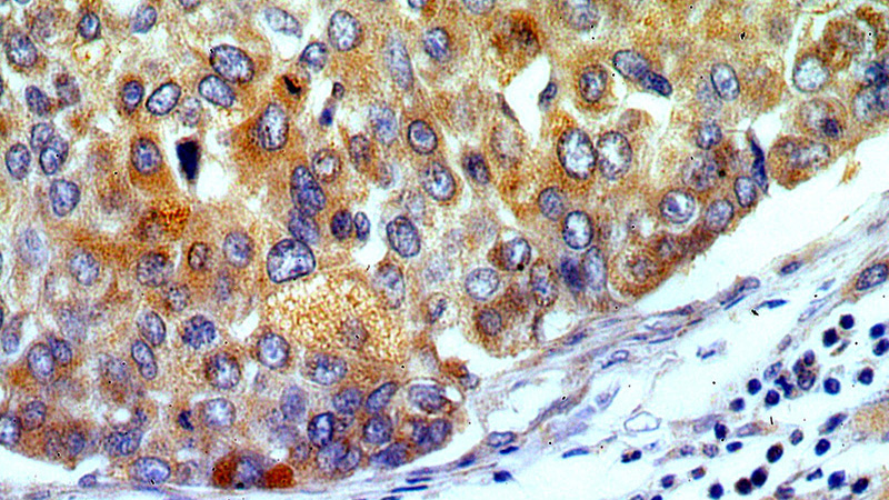 Immunohistochemical of paraffin-embedded human liver cancer using Catalog No:114425(RAB27A antibody) at dilution of 1:100 (under 40x lens)