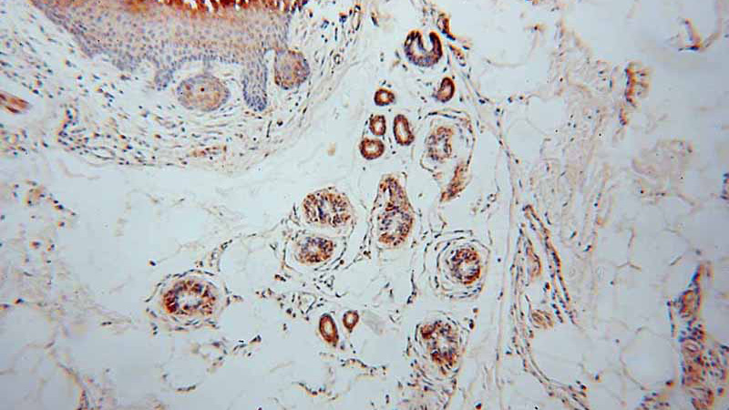 Immunohistochemical of paraffin-embedded human skin cancer using Catalog No:110867(GARS antibody) at dilution of 1:50 (under 10x lens)