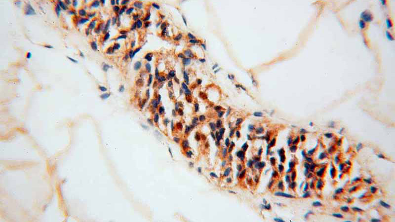 Immunohistochemical of paraffin-embedded human skin cancer using Catalog No:110411(EXOSC4 antibody) at dilution of 1:100 (under 40x lens)