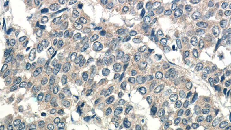 Immunohistochemistry of paraffin-embedded human colon cancer tissue slide using Catalog No:112308(LPO Antibody) at dilution of 1:50 (under 40x lens)