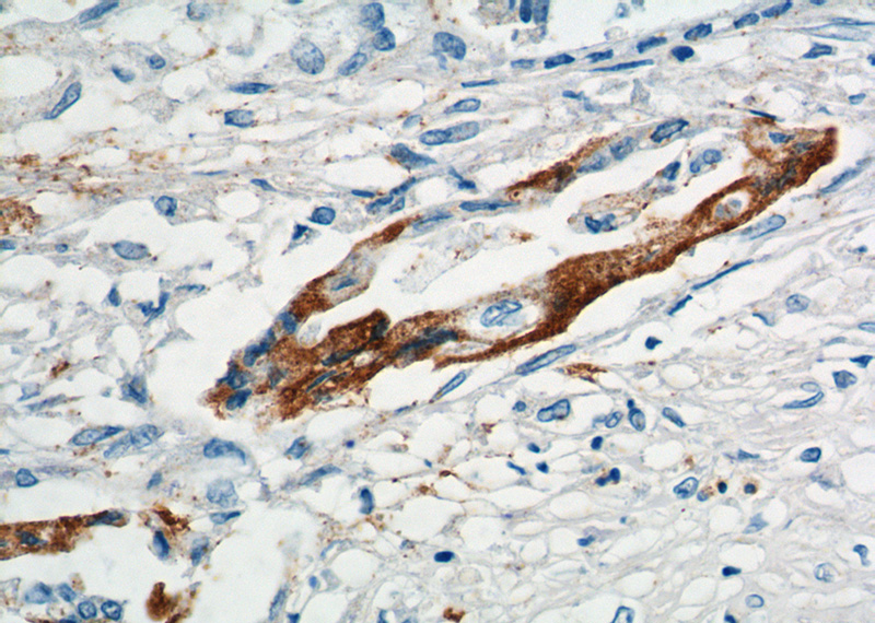 Immunohistochemistry of paraffin-embedded human pancreas cancer tissue slide using Catalog No:116988(XK Antibody) at dilution of 1:200 (under 40x lens).