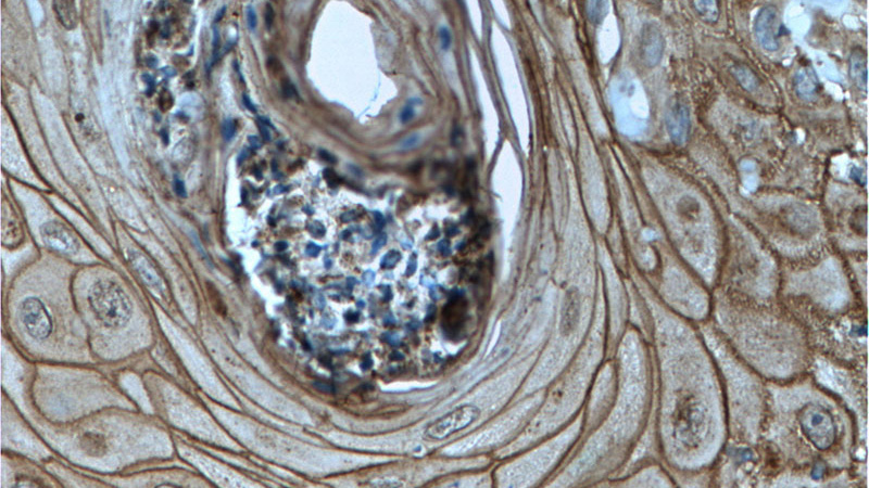Immunohistochemistry of paraffin-embedded human skin cancer tissue slide using Catalog No:110026(DSG1 Antibody) at dilution of 1:200 (under 40x lens). heat mediated antigen retrieved with Tris-EDTA buffer(pH9).
