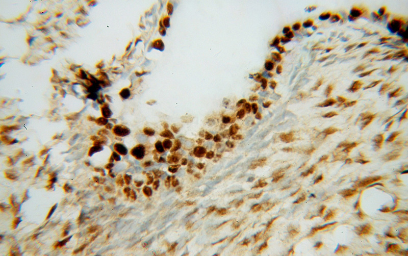 Immunohistochemical of paraffin-embedded human ovary tumor using Catalog No:113578(PAPSS1 antibody) at dilution of 1:100 (under 40x lens)