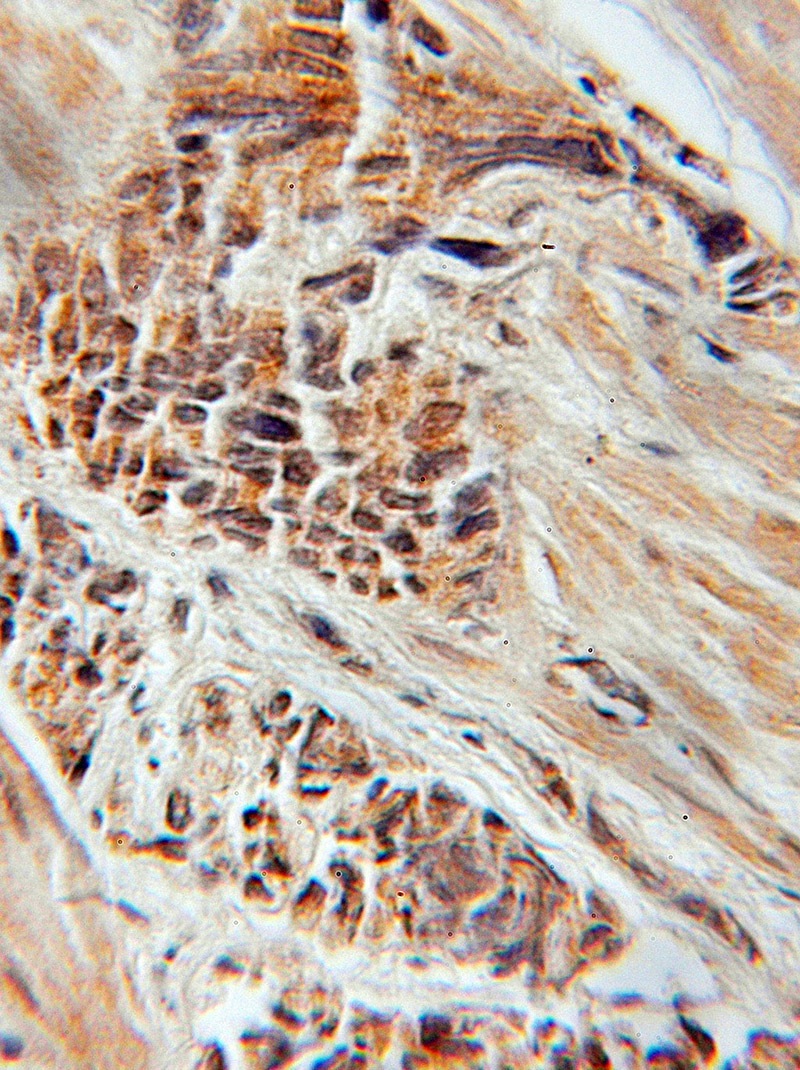 Immunohistochemical of paraffin-embedded human prostate cancer using Catalog No:116170(TOM1L1 antibody) at dilution of 1:50 (under 10x lens)