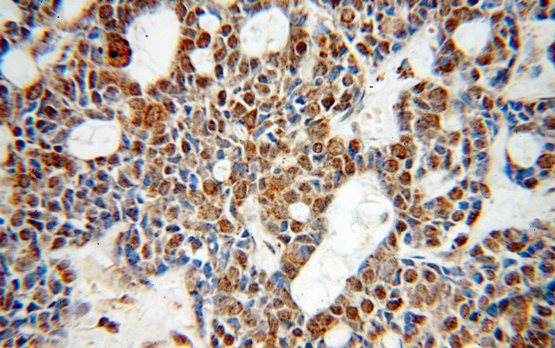 Immunohistochemical of paraffin-embedded human cervical cancer using Catalog No:116926(ZC3H4 antibody) at dilution of 1:50 (under 40x lens)