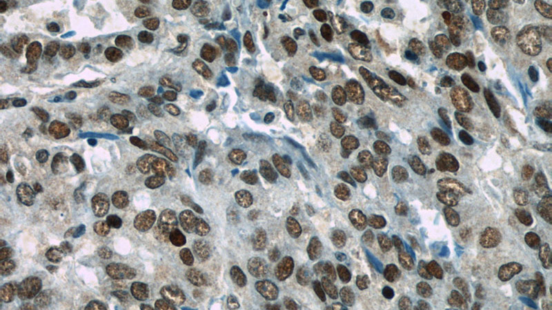 Immunohistochemistry of paraffin-embedded human ovary tumor slide using Catalog No:111725(HuR Antibody) at dilution of 1:50