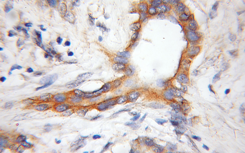 Immunohistochemical of paraffin-embedded human pancreas cancer using Catalog No:109483(COX11 antibody) at dilution of 1:50 (under 10x lens)