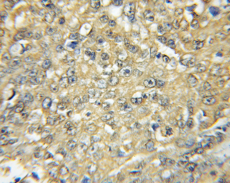 Immunohistochemical of paraffin-embedded human lung cancer using Catalog No:111282(HCK antibody) at dilution of 1:50 (under 10x lens)