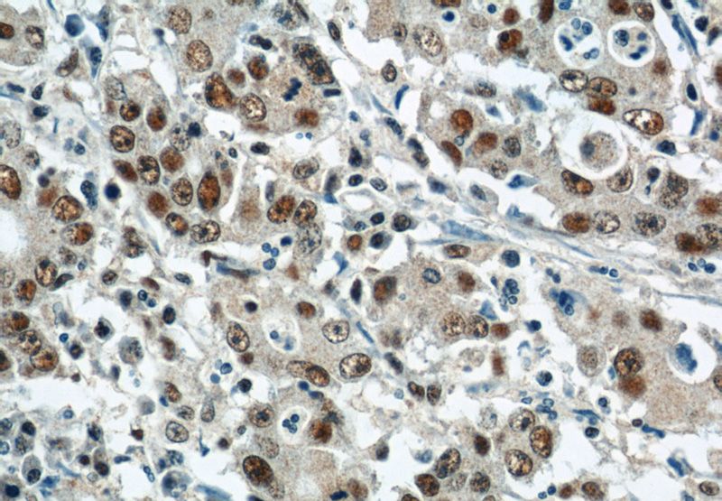 Immunohistochemical of paraffin-embedded human stomach cancer using Catalog No:109167(CDK8 antibody) at dilution of 1:50 (under 40x lens)
