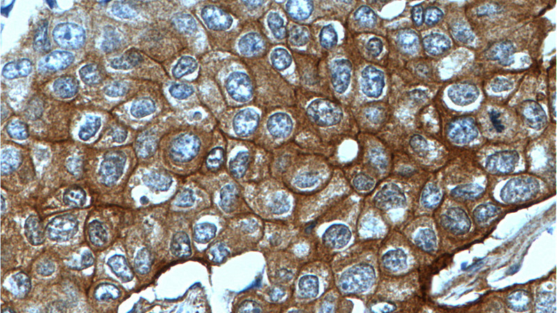 Immunohistochemistry of paraffin-embedded human breast cancer tissue slide using Catalog No:110245(ENAH Antibody) at dilution of 1:200 (under 40x lens).