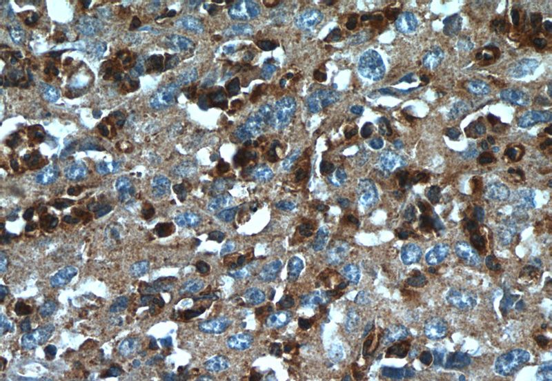 Immunohistochemistry of paraffin-embedded human cervical cancer tissue slide using Catalog No:116448(TXNDC16 Antibody) at dilution of 1:50 (under 40x lens)