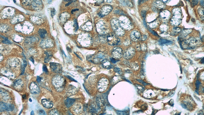 Immunohistochemistry of paraffin-embedded human breast cancer slide using Catalog No:107444(P4HA1 Antibody) at dilution of 1:50