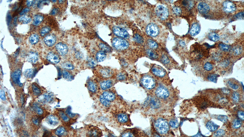 Immunohistochemistry of paraffin-embedded human breast cancer tissue slide using Catalog No:114183(PRELID1 Antibody) at dilution of 1:200 (under 40x lens).