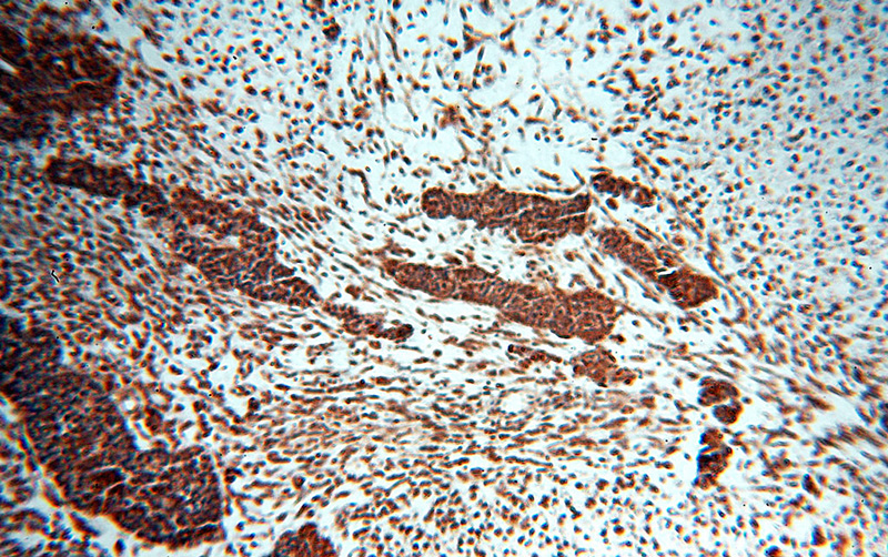Immunohistochemical of paraffin-embedded human ovary tumor using Catalog No:111375(HDAC3 antibody) at dilution of 1:50 (under 10x lens)